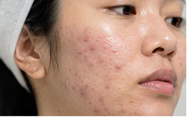 ภาพประกอบโปรแกรมรักษาสิว Acne Clear สำหรับดูแลสิวอักเสบ สิวอุดตัน และรอยแดงจากสิว
