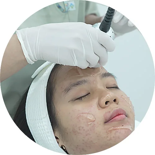 ภาพประกอบทรีตเมนต์ดูแลรอยแดงจากสิวในโปรแกรม Acne Clear