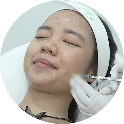 ภาพประกอบขั้นตอนฉีดวิตามินบำรุงผิวในโปรแกรม Acne Clear
