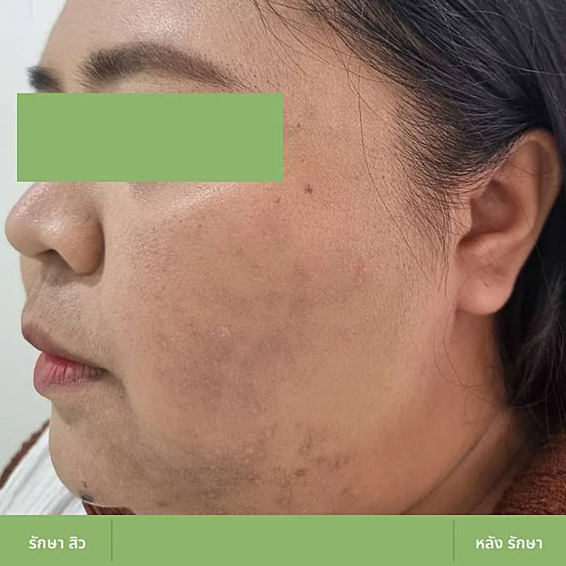 ตัวอย่างเคส Acne Clear 01 หลังดูแลปัญหาสิว