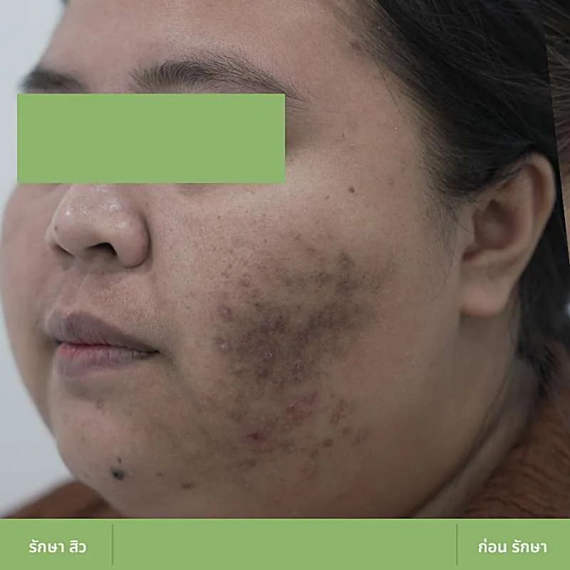 ตัวอย่างเคส Acne Clear 01 ก่อนดูแลปัญหาสิว