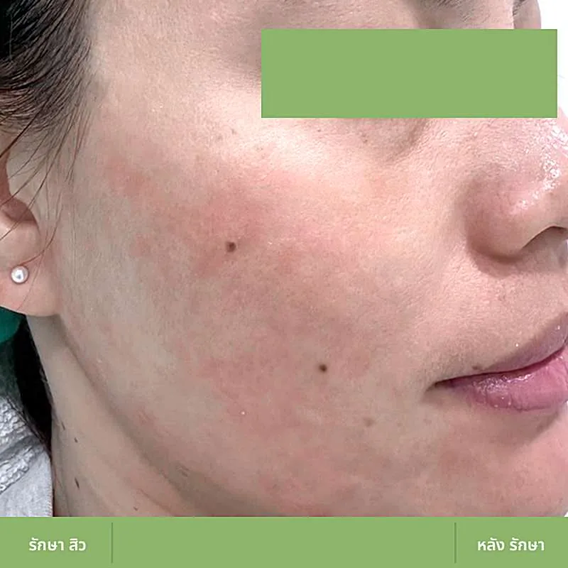 ตัวอย่างเคส Acne Clear 02 หลังดูแลปัญหาสิว