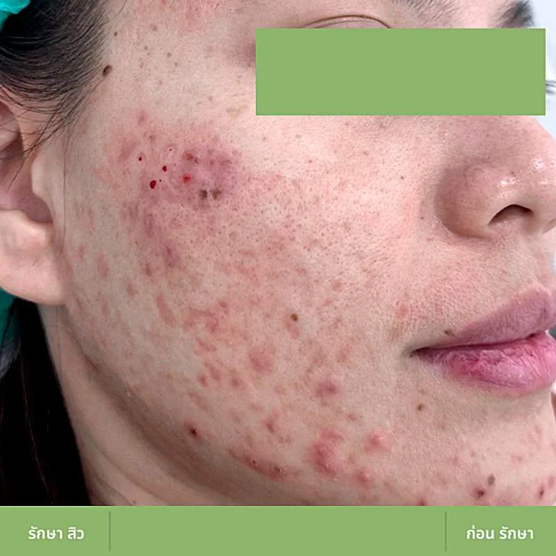 ตัวอย่างเคส Acne Clear 02 ก่อนดูแลปัญหาสิว