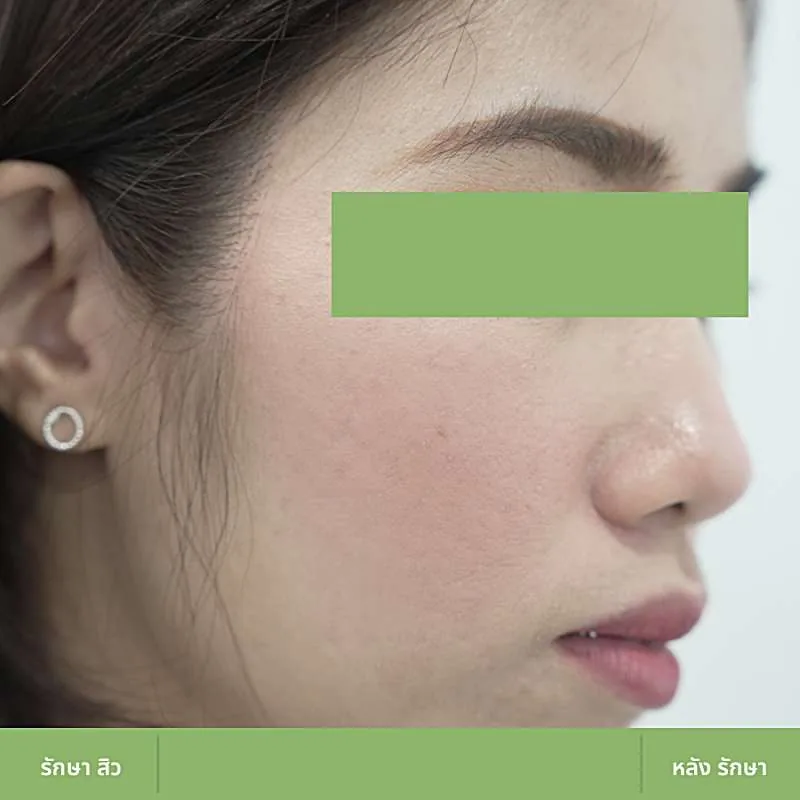 ตัวอย่างเคส Acne Clear 03 หลังดูแลปัญหาสิว