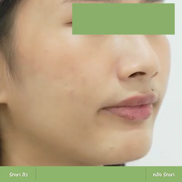 ตัวอย่างเคส Acne Clear 04 หลังดูแลปัญหาสิว