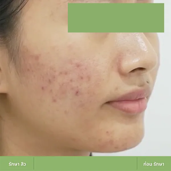 ตัวอย่างเคส Acne Clear 04 ก่อนดูแลปัญหาสิว
