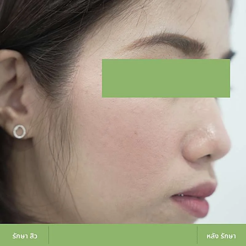 ตัวอย่างเคส Acne Clear 05 หลังดูแลปัญหาสิว