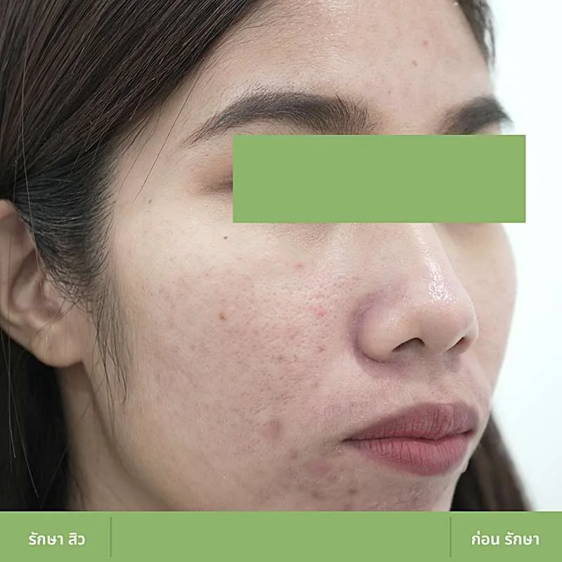 ตัวอย่างเคส Acne Clear 05 ก่อนดูแลปัญหาสิว