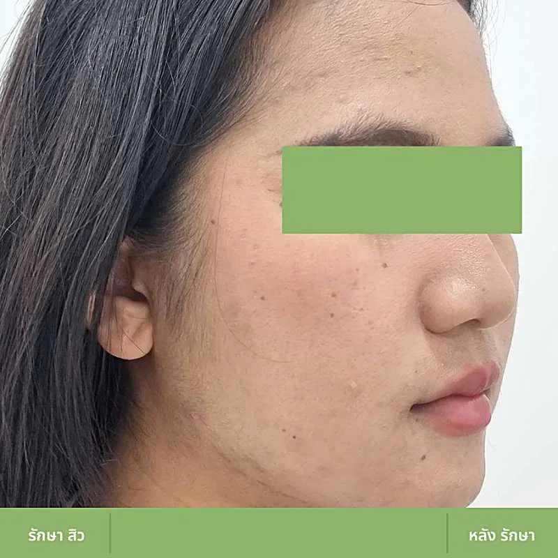 ตัวอย่างเคส Acne Clear 06 หลังดูแลปัญหาสิว