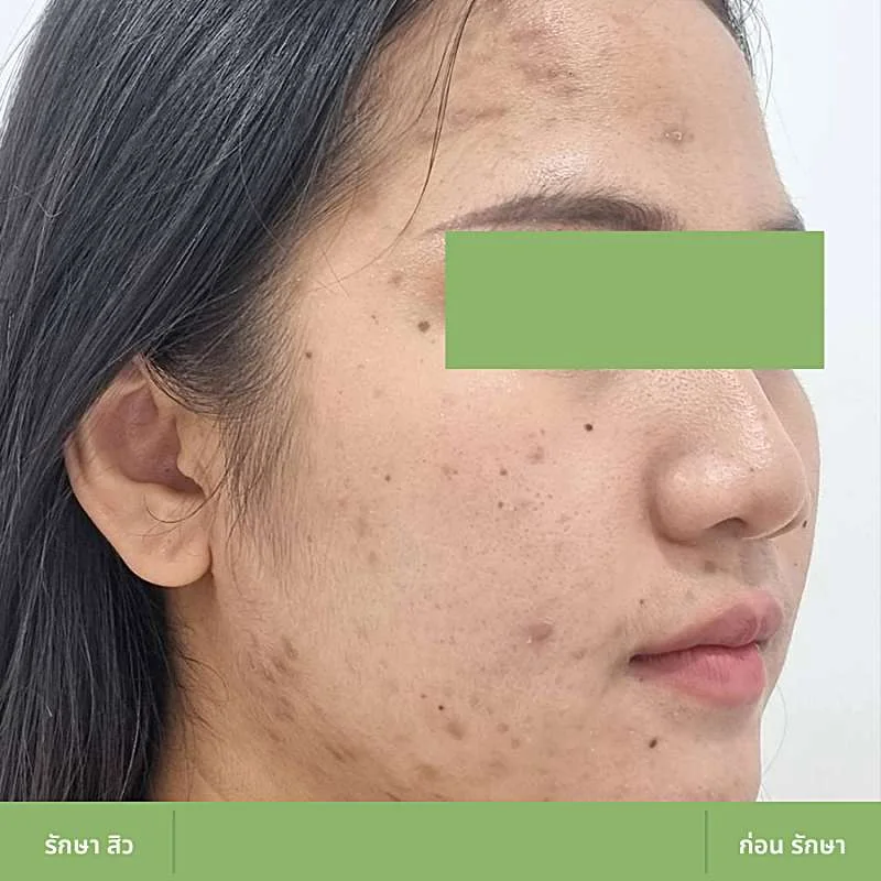 ตัวอย่างเคส Acne Clear 06 ก่อนดูแลปัญหาสิว