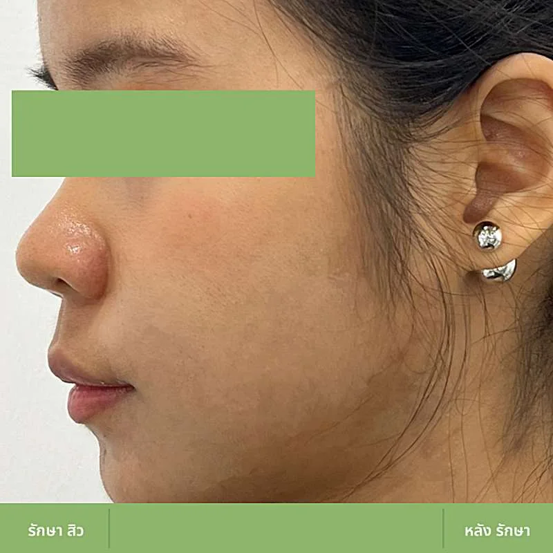 ตัวอย่างเคส Acne Clear 07 หลังดูแลปัญหาสิว