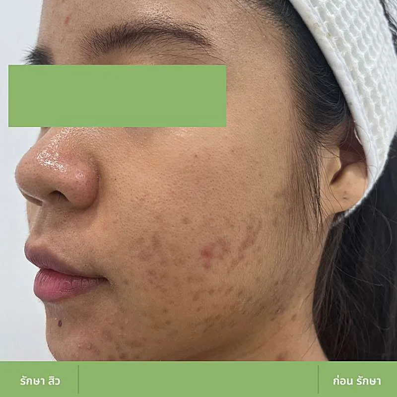 ตัวอย่างเคส Acne Clear 07 ก่อนดูแลปัญหาสิว